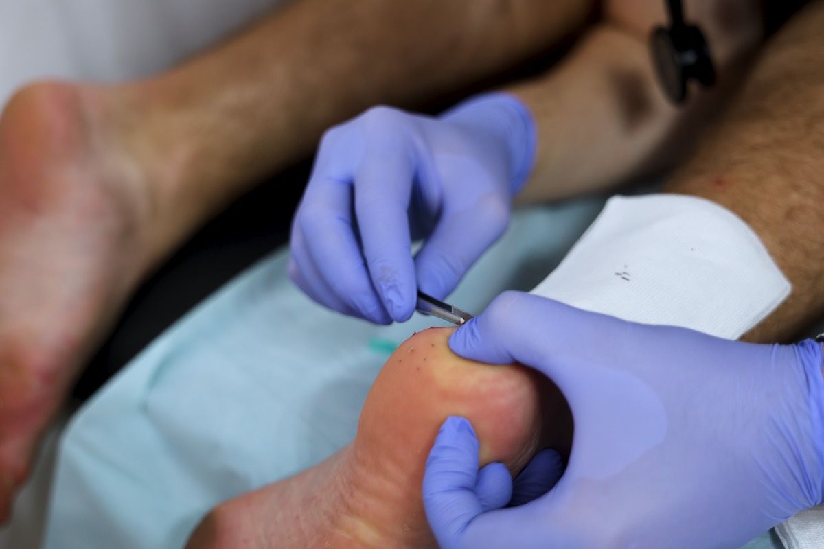 Medical treatment of sea urchin spines at CissaMed in Novalja, Croatia